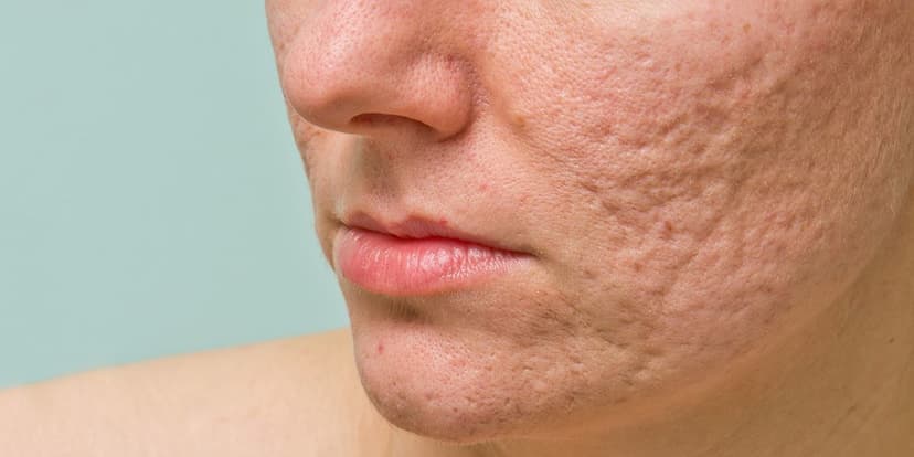 How to Get Rid of Acne Scars: Treatment Options That Work